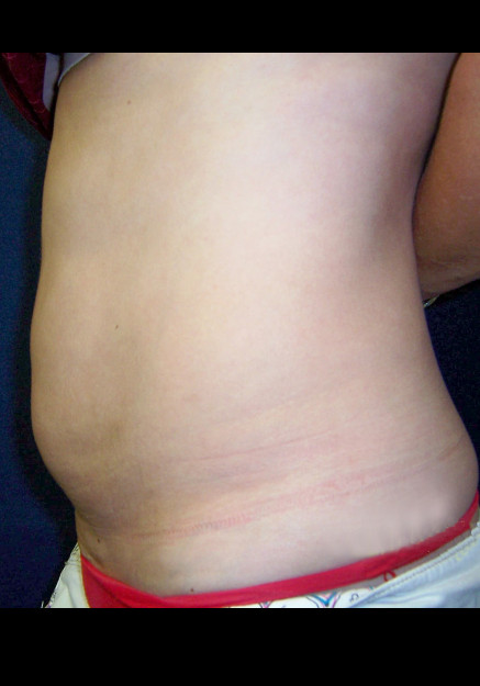 Vaser Liposuction – Case 24
