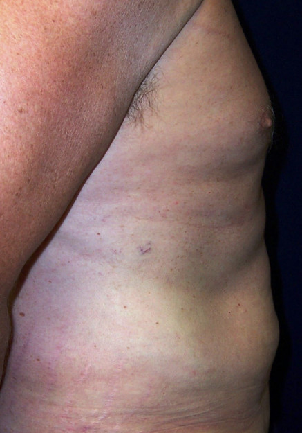 Vaser Liposuction – Case 25