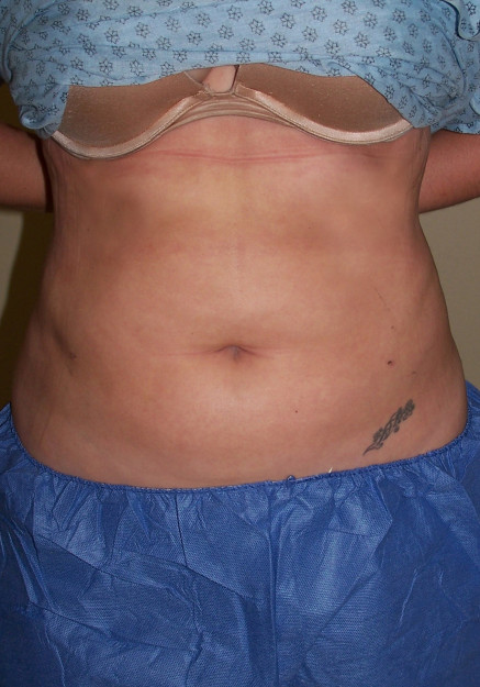 Vaser Liposuction – Case 26