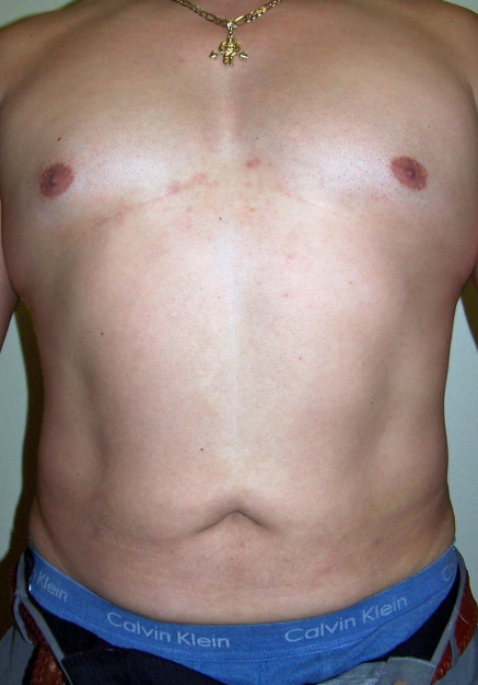 Vaser Liposuction – Case 28