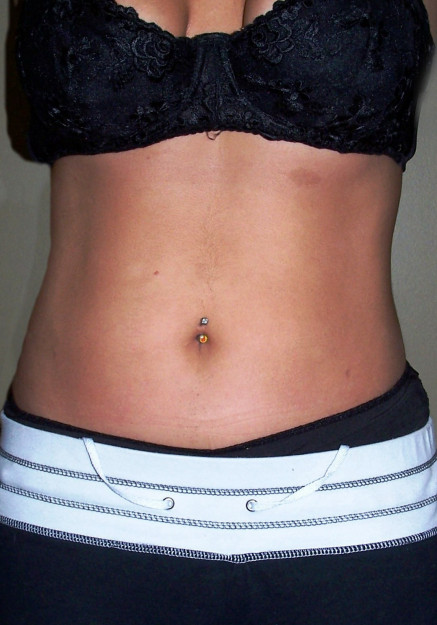 Vaser Liposuction – Case 29