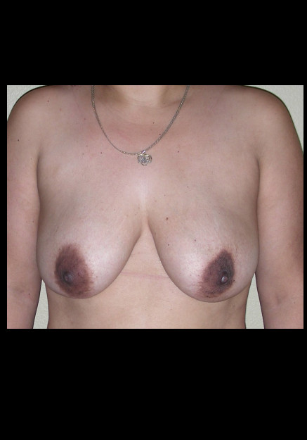 Breast Lift- Case 3
