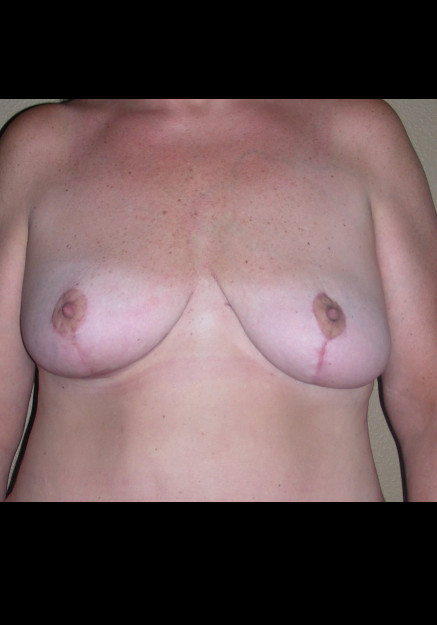Breast Lift – Case 6