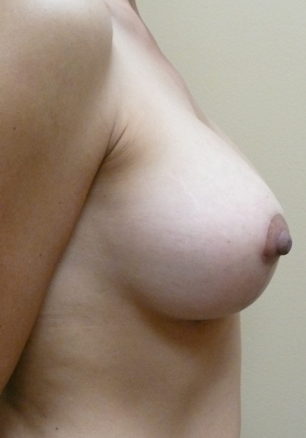 Breast Lift – Case 9
