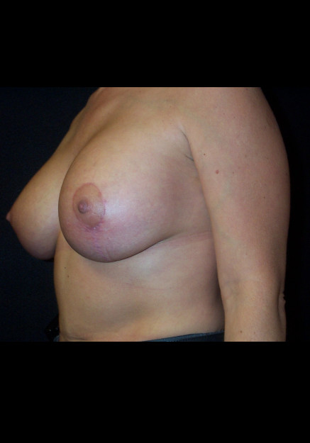 Breast Lift – Case 14