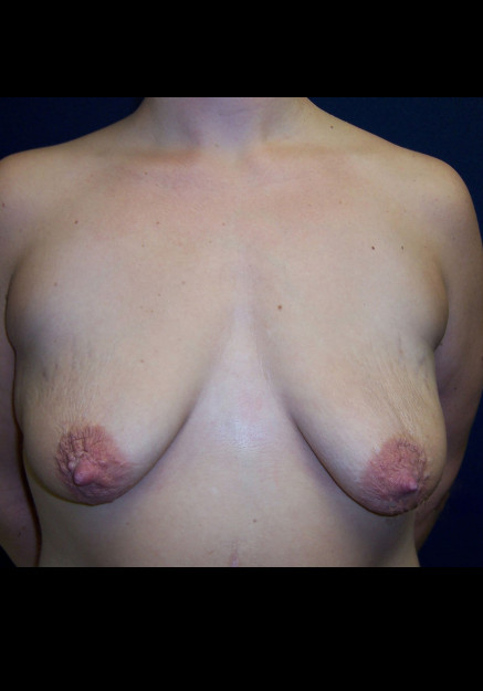 Breast Lift – Case 15