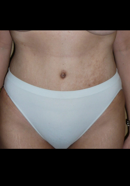 Tummy Tuck – Case 2