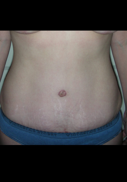 Tummy Tuck – Case 3