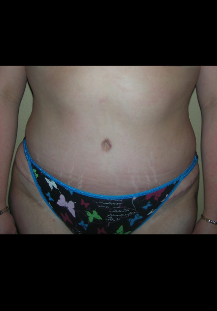 Tummy Tuck – Case 4