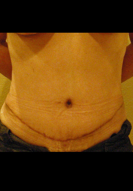 Tummy Tuck – Case 5