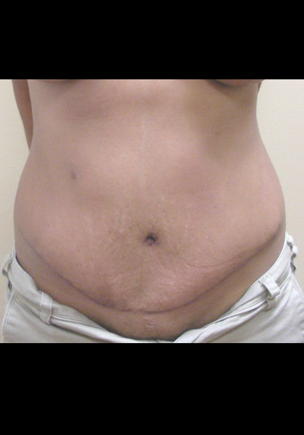 Tummy Tuck – Case 6