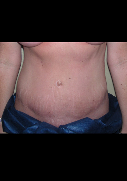 Tummy Tuck – Case 7