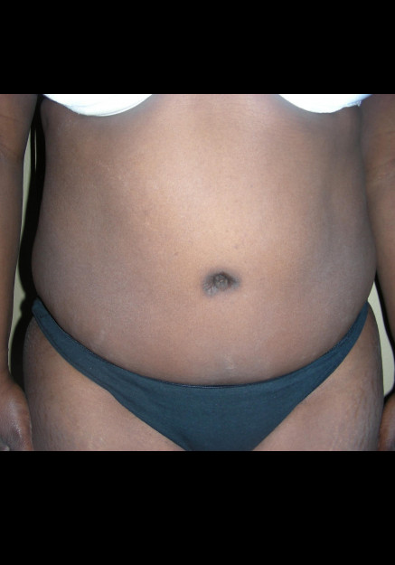 Tummy Tuck – Case 8