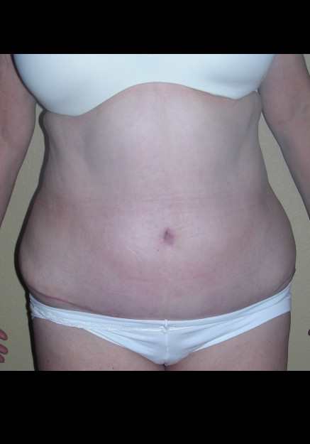 Tummy Tuck – Case 9