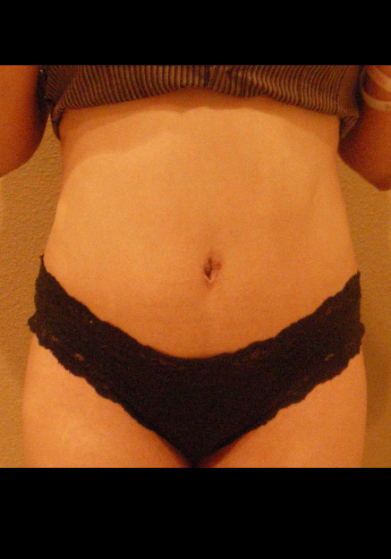 Tummy Tuck – Case 10
