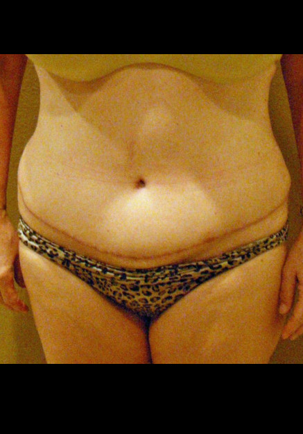 Tummy Tuck – Case 11