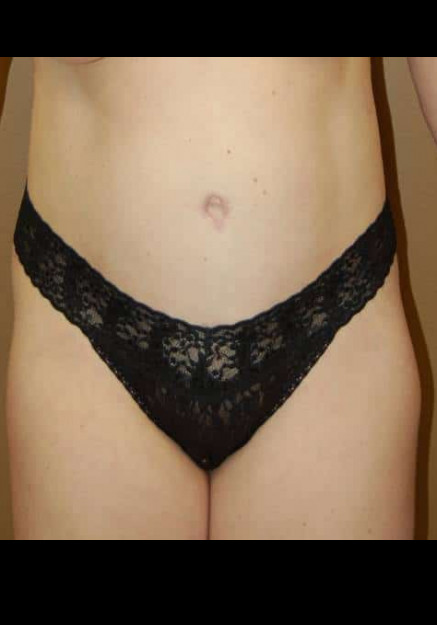 Tummy Tuck – Case 13