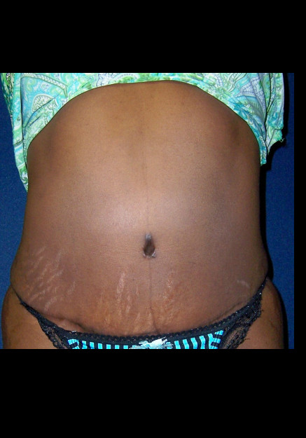 Tummy Tuck – Case 14