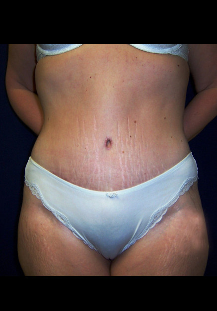 Tummy Tuck – Case 16