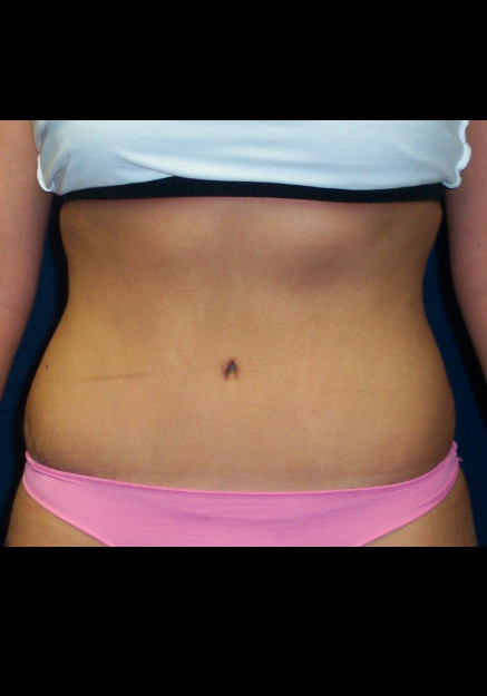 Tummy Tuck – Case 17