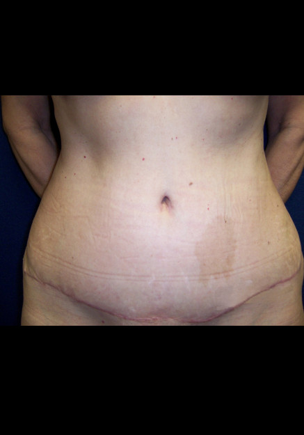 Tummy Tuck – Case 18