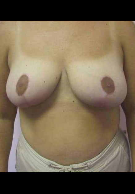 Breast Reduction – Case 2