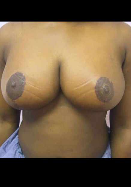 Breast Reduction – Case 3