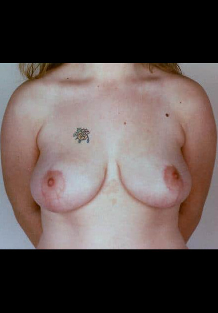 Breast Reduction – Case 4