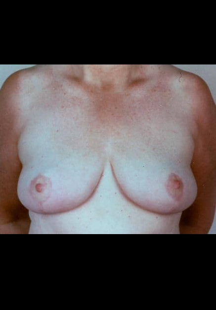 Breast Reduction – Case 5