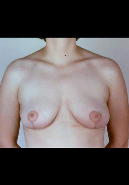 Breast Reduction – Case 6