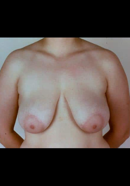 Breast Reduction – Case 6