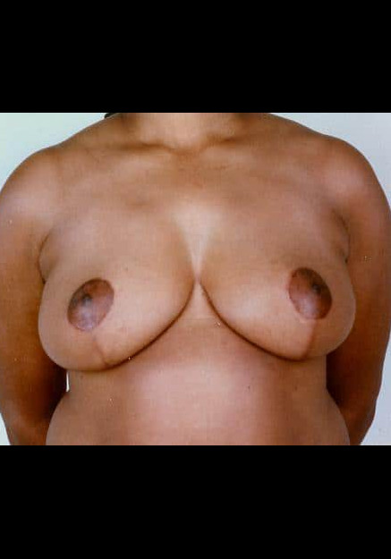 Breast Reduction – Case 7