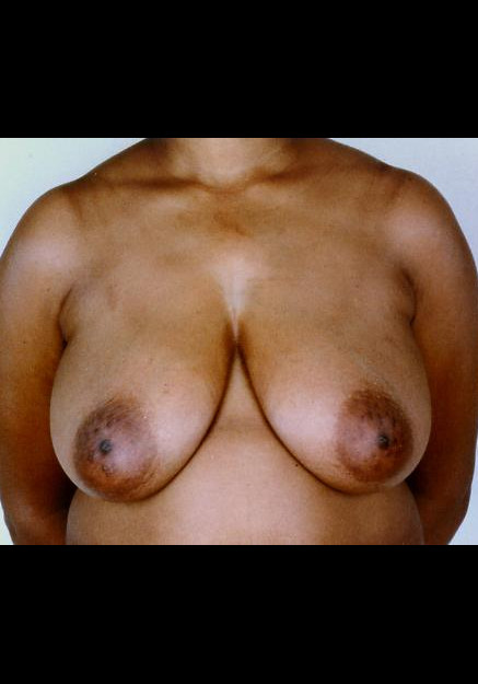 Breast Reduction – Case 7