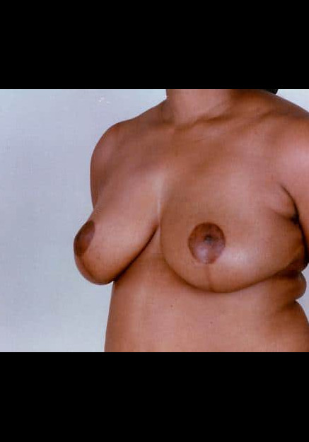 Breast Reduction – Case 7
