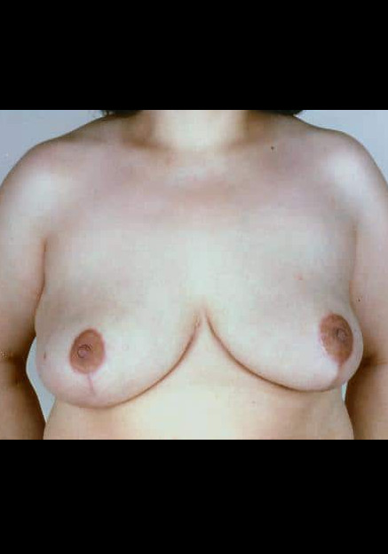 Breast Reduction – Case 8