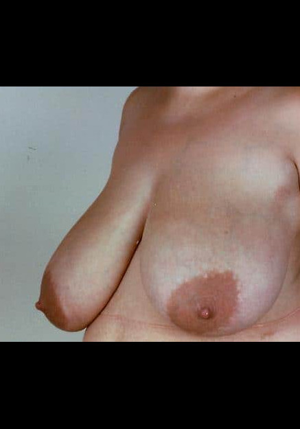 Breast Reduction – Case 8