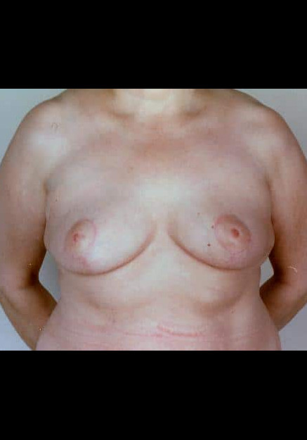 Breast Reduction – Case 9