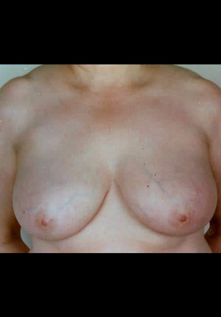 Breast Reduction – Case 9