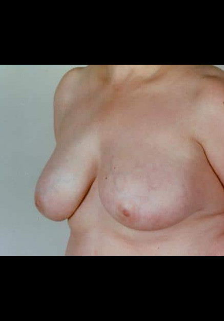 Breast Reduction – Case 9