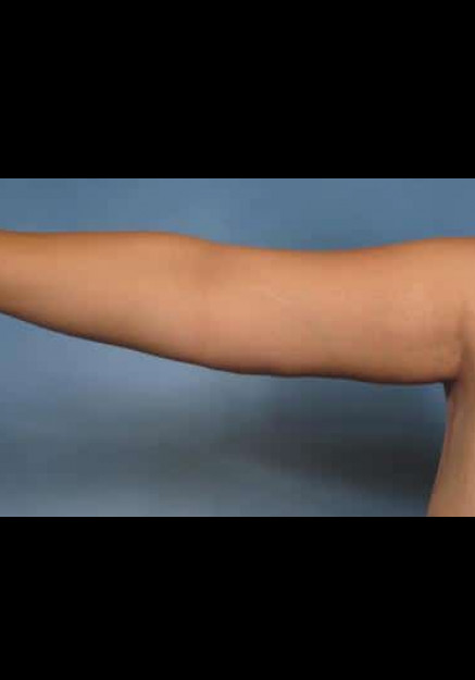 Arm Lift – Case 2