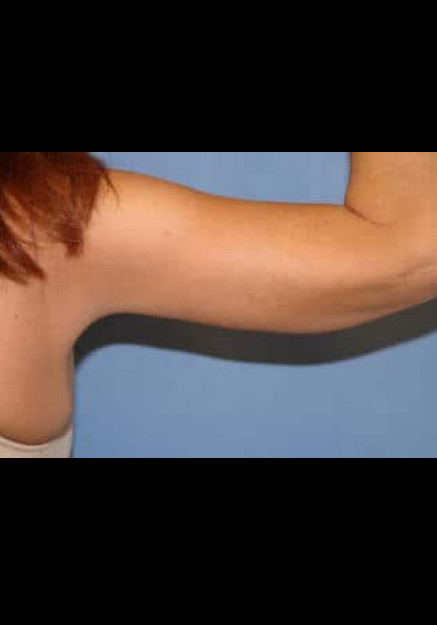 Arm Lift – Case 3