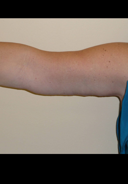 Arm Lift – Case 7