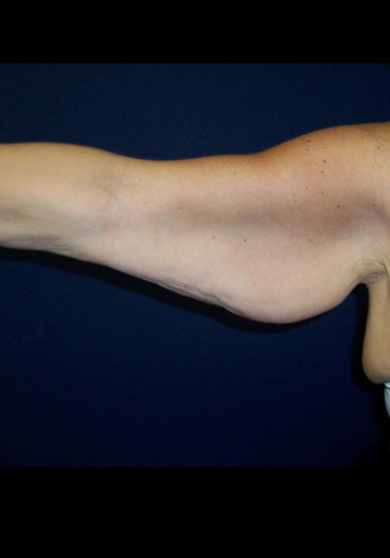 Arm Lift – Case 7