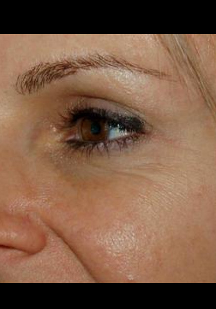 Botox – Case 3