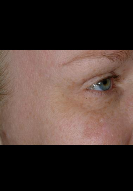 Botox – Case 6