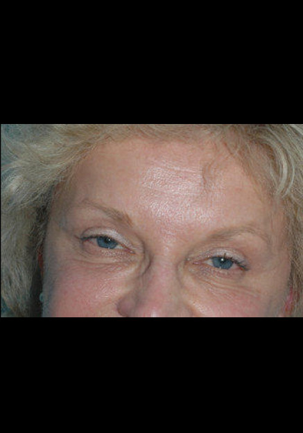 Botox – Case 7