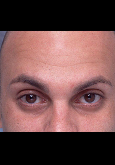 Botox – Case 8