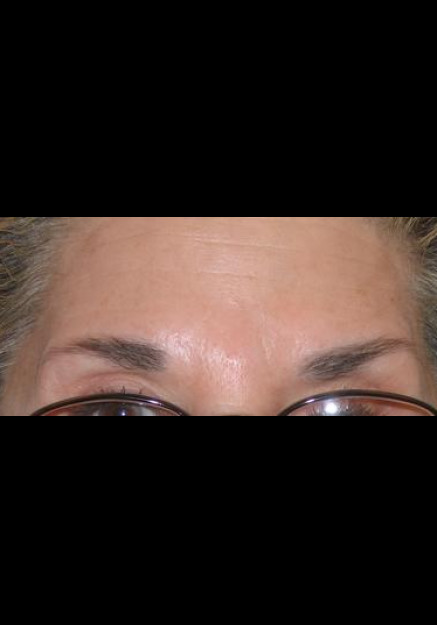 Botox – Case 9