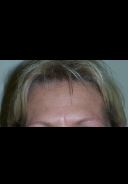 Botox – Case 10