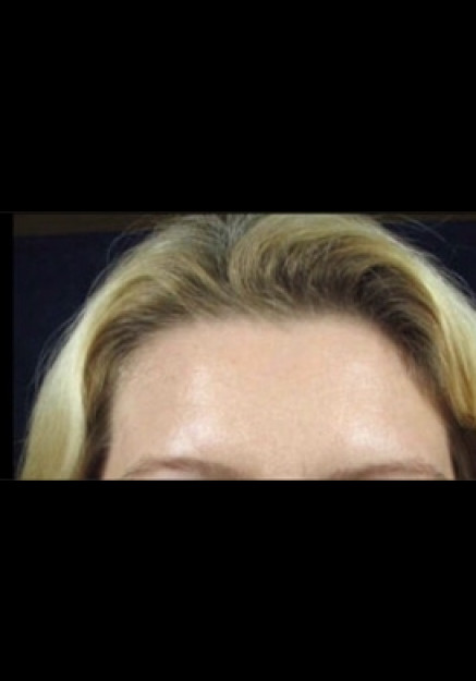 Botox – Case 11